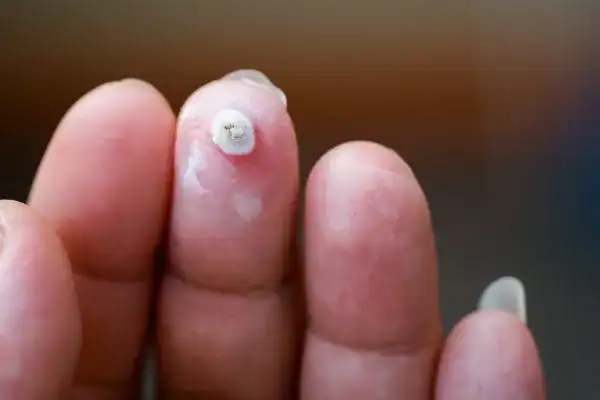 Image of white wart before cryopen treatment Scunthorpe
