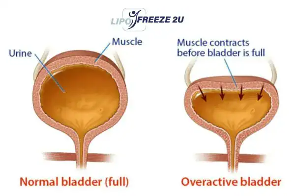 diagram of overactive bladder treatment Scunthorpe