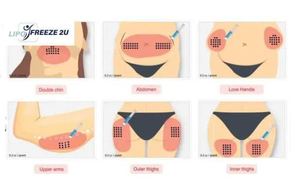 Benefits of Choosing Aqualyx for Fat Reduction Scunthorpe