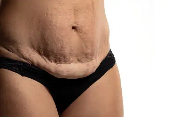 loose skin after weight loss injections Scunthorpe