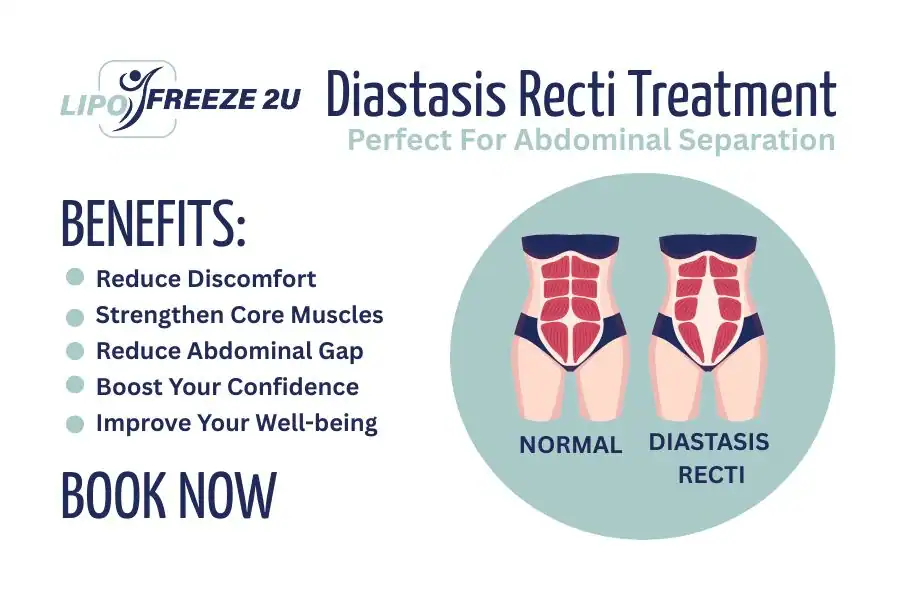 Benefits of body toning treatment Scunthorpe for Diastasis recti