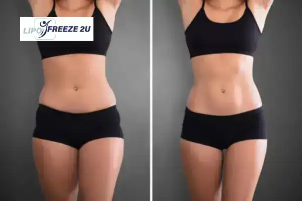 How Can LIPO FREEZE 2U Support Your Post-Pregnancy Body Recovery Scunthorpe?