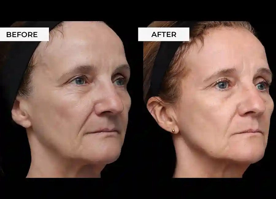 How Many RF Microneedling Sessions Will You Need to See a Difference Scunthorpe?