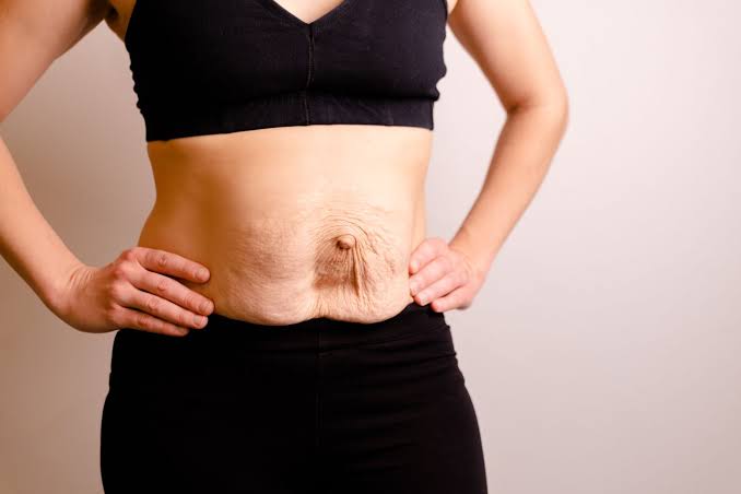 Is Surgery Really the Only Way to Repair Diastasis Recti Scunthorpe?