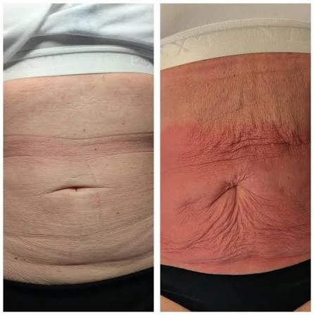 How Does RF Microneedling Improve Crepey, Thin and Uneven Skin Texture Scunthorpe?