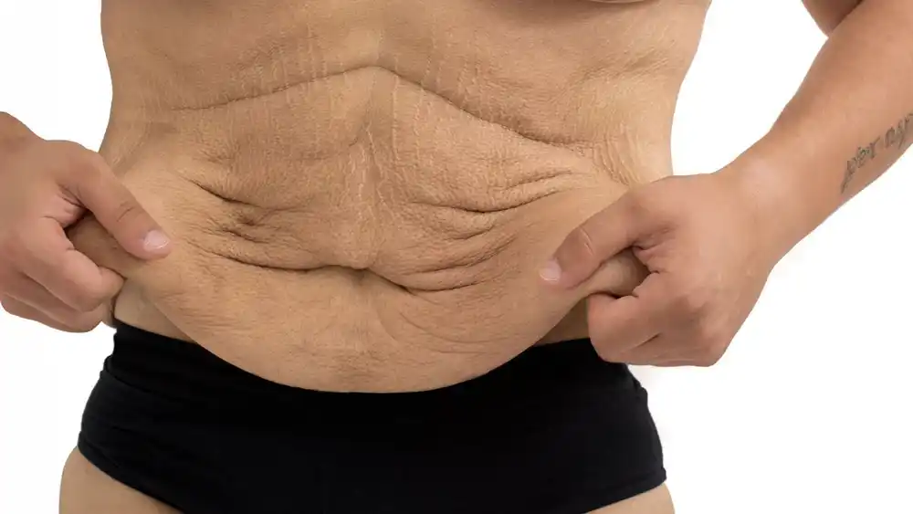 Why Does Weight Loss Medication Leave Some People With Loose or Sagging Skin Scunthorpe?